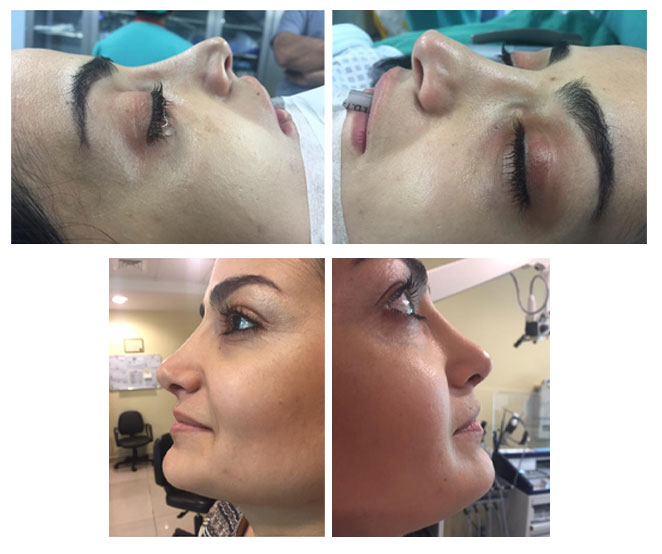 Rhinoplasty